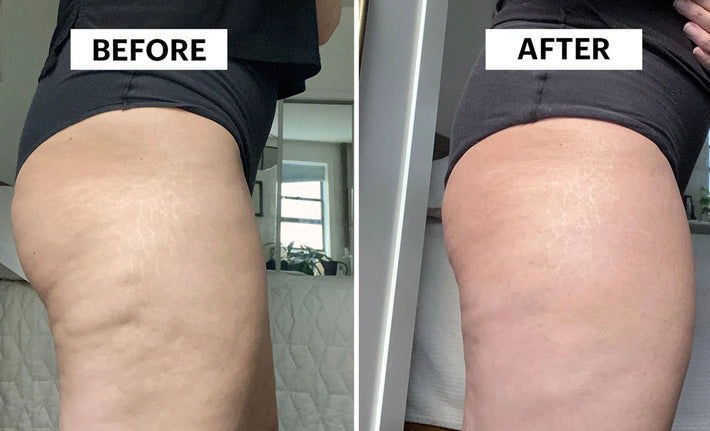 Anti-Cellulite Massager